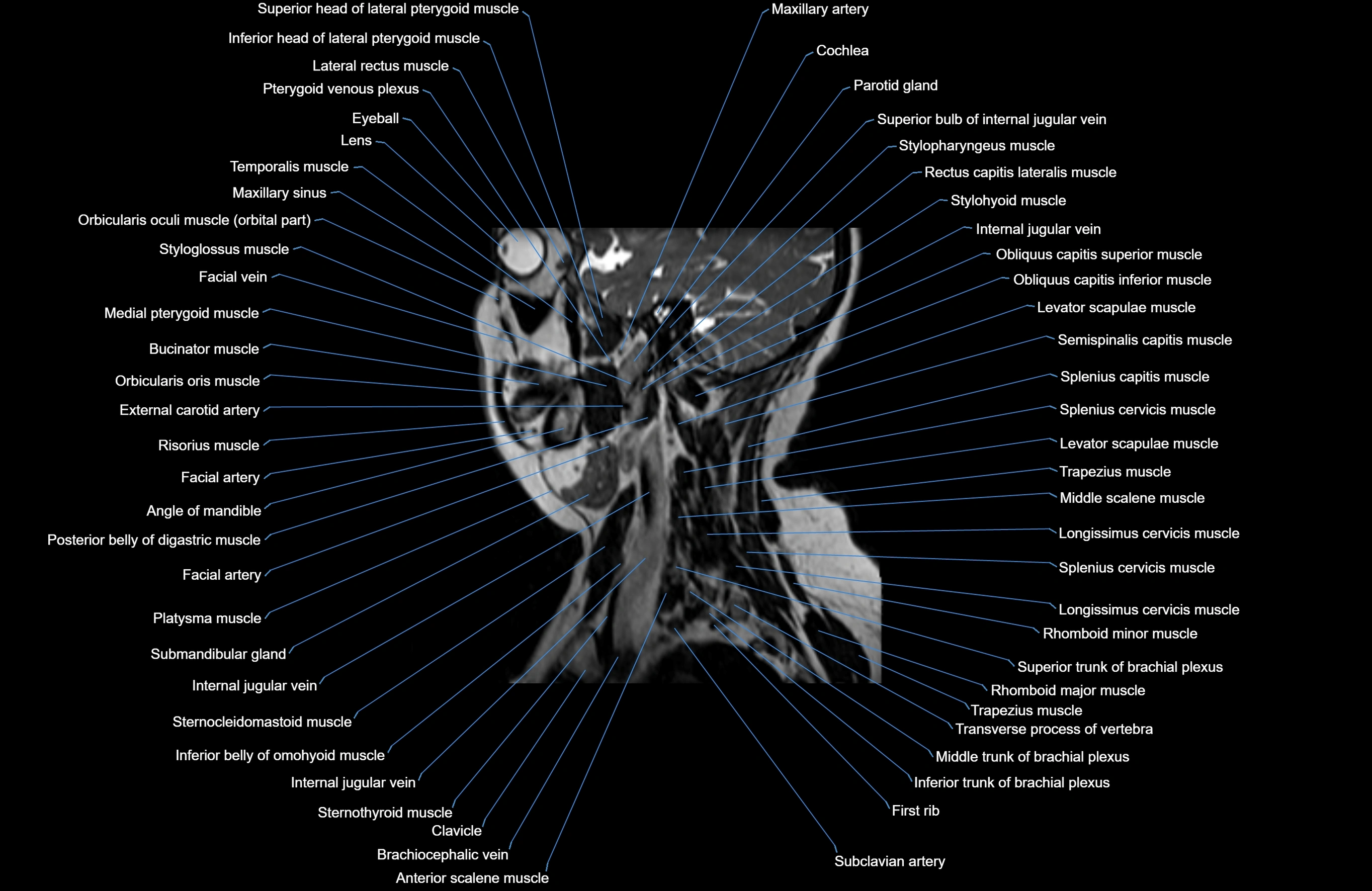 Neck MRI sagittal cross sectional anatomy 3D 1mm 3T radiology  image-img-00001-00022.webp